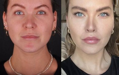 before-after photo endoscopic-facelift