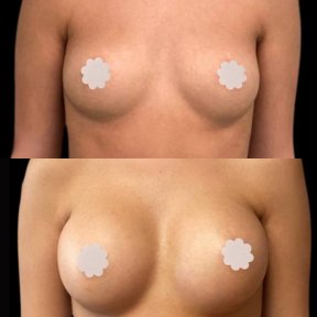 before-after photo breast-augmentation
