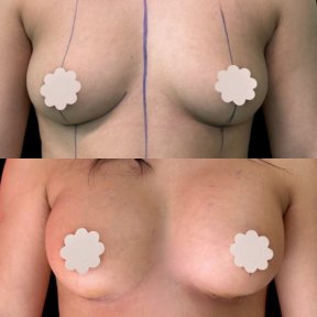 before-after photo breast-augmentation