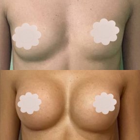before-after photo breast-augmentation