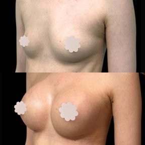 before-after photo breast-augmentation
