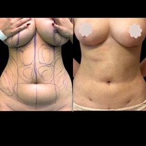 before-after photo mommy-makeover