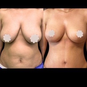 before-after photo mommy-makeover