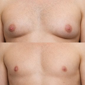 before-after photo gynecomastia-surgery