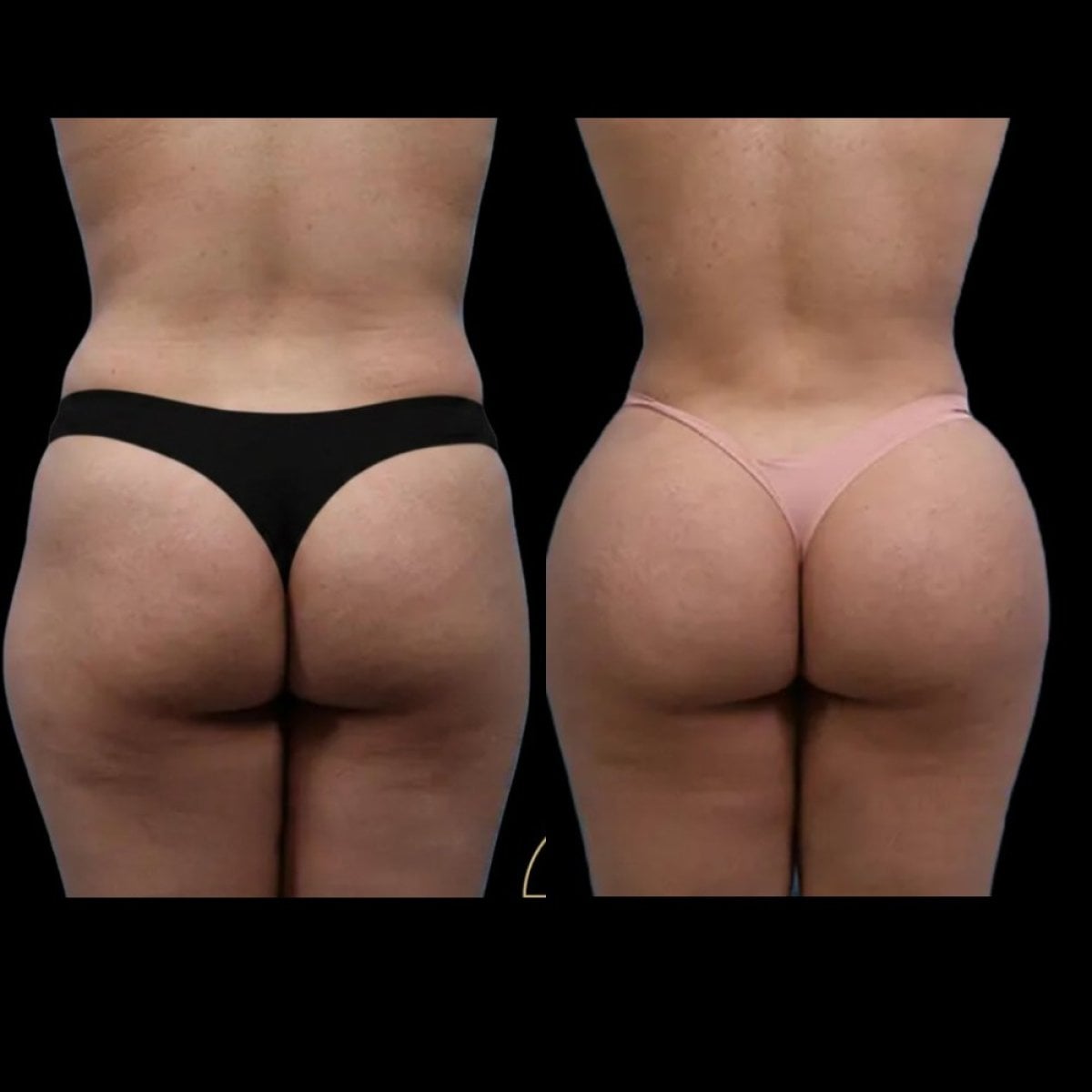 نتائج قبل وبعد عملية شد المؤخرة البرازيلية في EDEN AESTHETICS Clinic، تحسين الشكل