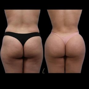 Before and after Brazilian Butt Lift results at EDEN AESTHETICS Clinic, enhanced contour