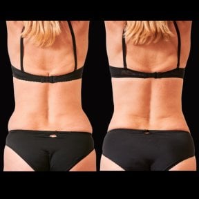 before-after photo liposuction