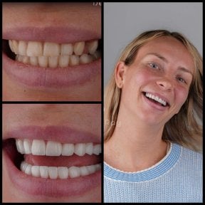 before-after photo hollywood-smile