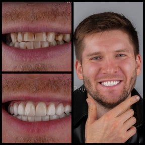 before-after photo hollywood-smile