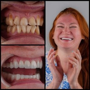 before-after photo hollywood-smile