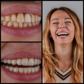 before-after photo hollywood-smile