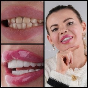 before-after photo hollywood-smile