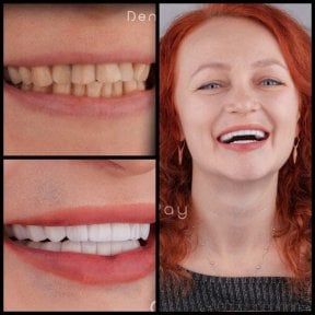 before-after photo hollywood-smile