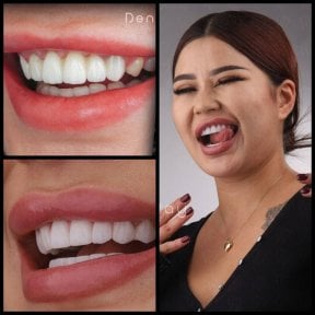 before-after photo hollywood-smile
