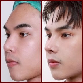 before-after photo septoplasty