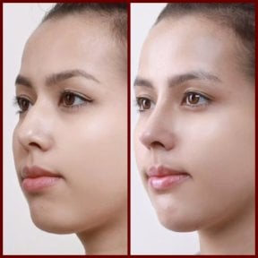 before-after photo septoplasty