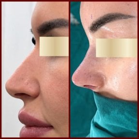 before-after photo septoplasty