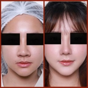 before-after photo septoplasty