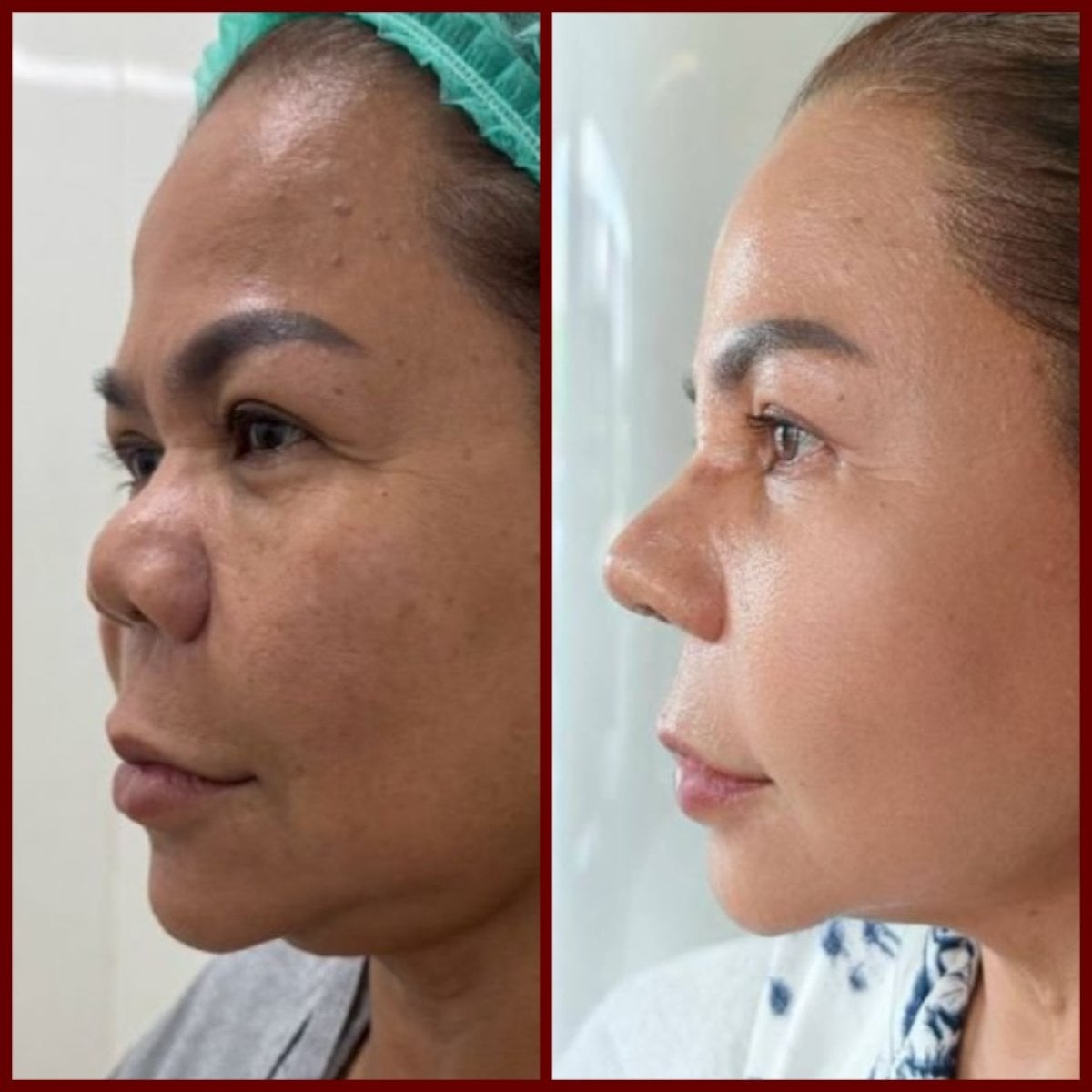 Resultados de septoplastia antes y después en DGB Clinic, mejora de la forma nasal tras cirugía