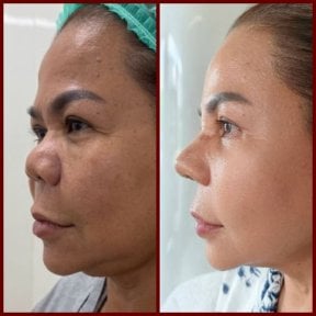before-after photo septoplasty