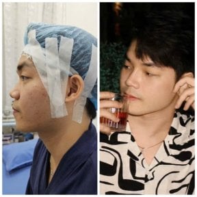 before-after photo rhinoplasty-nose-job