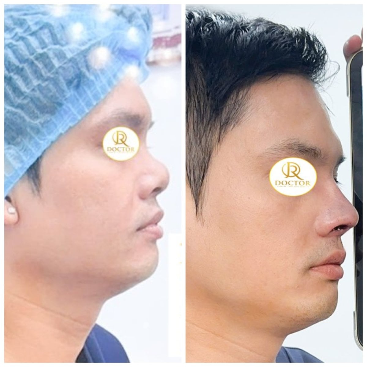 نتائج تجميل الأنف قبل وبعد في Doctor International Aesthetics، تحسين شكل الأنف الجانبي