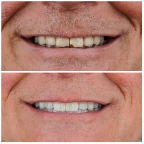 before-after photo dental-implant