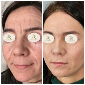 Результаты до и после подтяжки лица в Doctor International Aesthetics, гладкая кожа