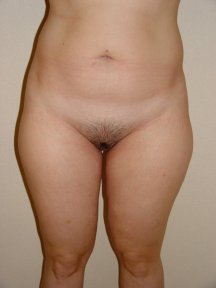 before-after photo bodytite-body-contouring