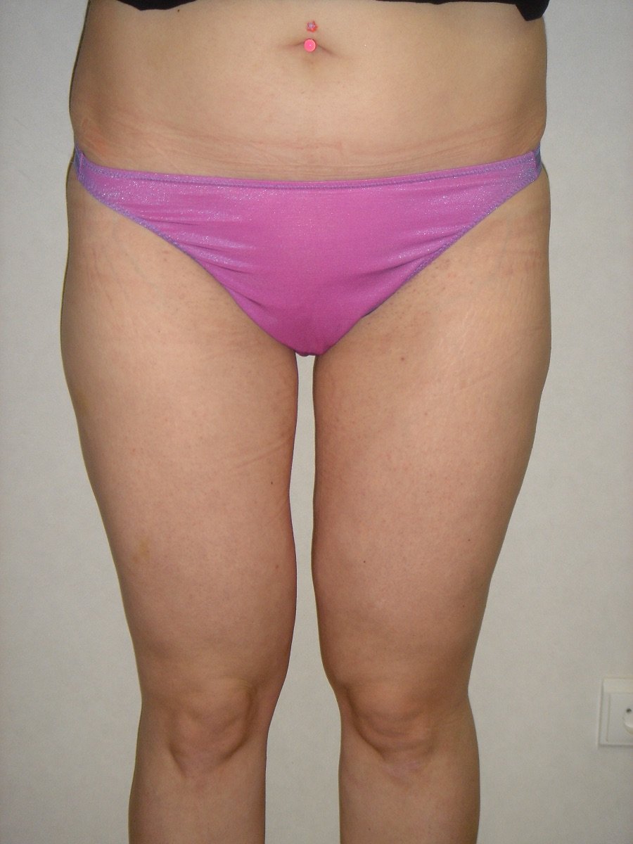 Resultado de BodyTite en Clinica Granado Tiagonce, mejora en la forma de los muslos