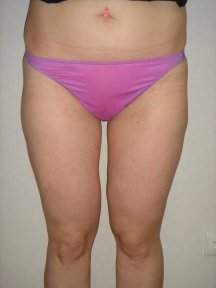 before-after photo bodytite-body-contouring