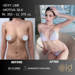 before-after photo tightening-of-facial-skin-facelift