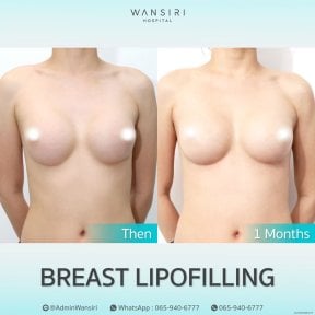 before-after photo liposuction