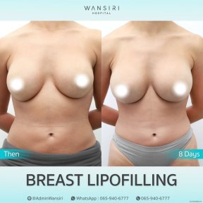 before-after photo liposuction