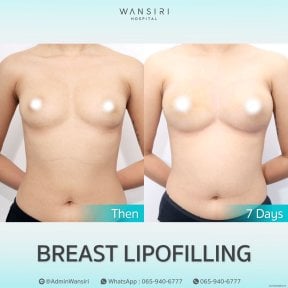 before-after photo liposuction
