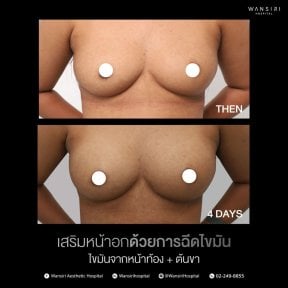 before-after photo liposuction
