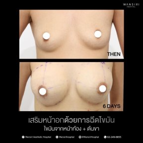 before-after photo liposuction