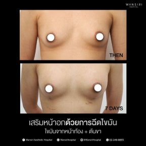 before-after photo liposuction