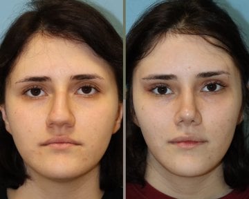 before-after photo upper-eyelid-surgery