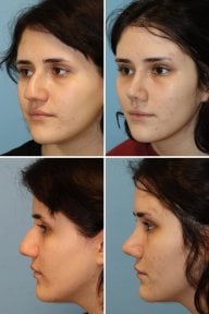 before-after photo upper-eyelid-surgery