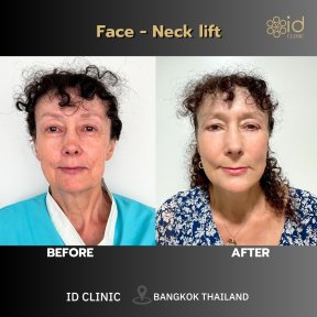 نتائج شد الوجه والرقبة قبل وبعد في ID Clinic Bangkok، تجديد ملحوظ