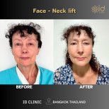 نتائج شد الوجه والرقبة قبل وبعد في ID Clinic Bangkok، تجديد ملحوظ