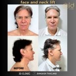 نتائج شد الوجه والرقبة قبل وبعد في ID Clinic Bangkok مع تجديد ملحوظ