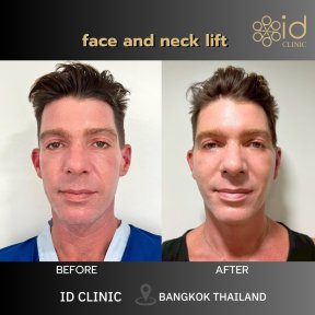 نتائج شد الوجه والرقبة قبل وبعد في ID Clinic Bangkok، تجديد شباب الوجه بوضوح