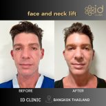 نتائج شد الوجه والرقبة قبل وبعد في ID Clinic Bangkok، تجديد شباب الوجه بوضوح