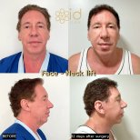 نتائج شد الوجه والرقبة قبل وبعد في ID Clinic Bangkok، تجديد ملحوظ خلال 12 يومًا