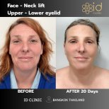 نتائج شد الوجه والرقبة وجراحة الجفون قبل وبعد في ID Clinic Bangkok