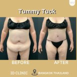نتائج شد البطن قبل وبعد في ID Clinic Bangkok مع تحسين واضح لشكل البطن
