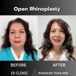 نتائج قبل وبعد عملية تجميل الأنف المفتوحة في ID Clinic Bangkok، تحسين شكل الأنف