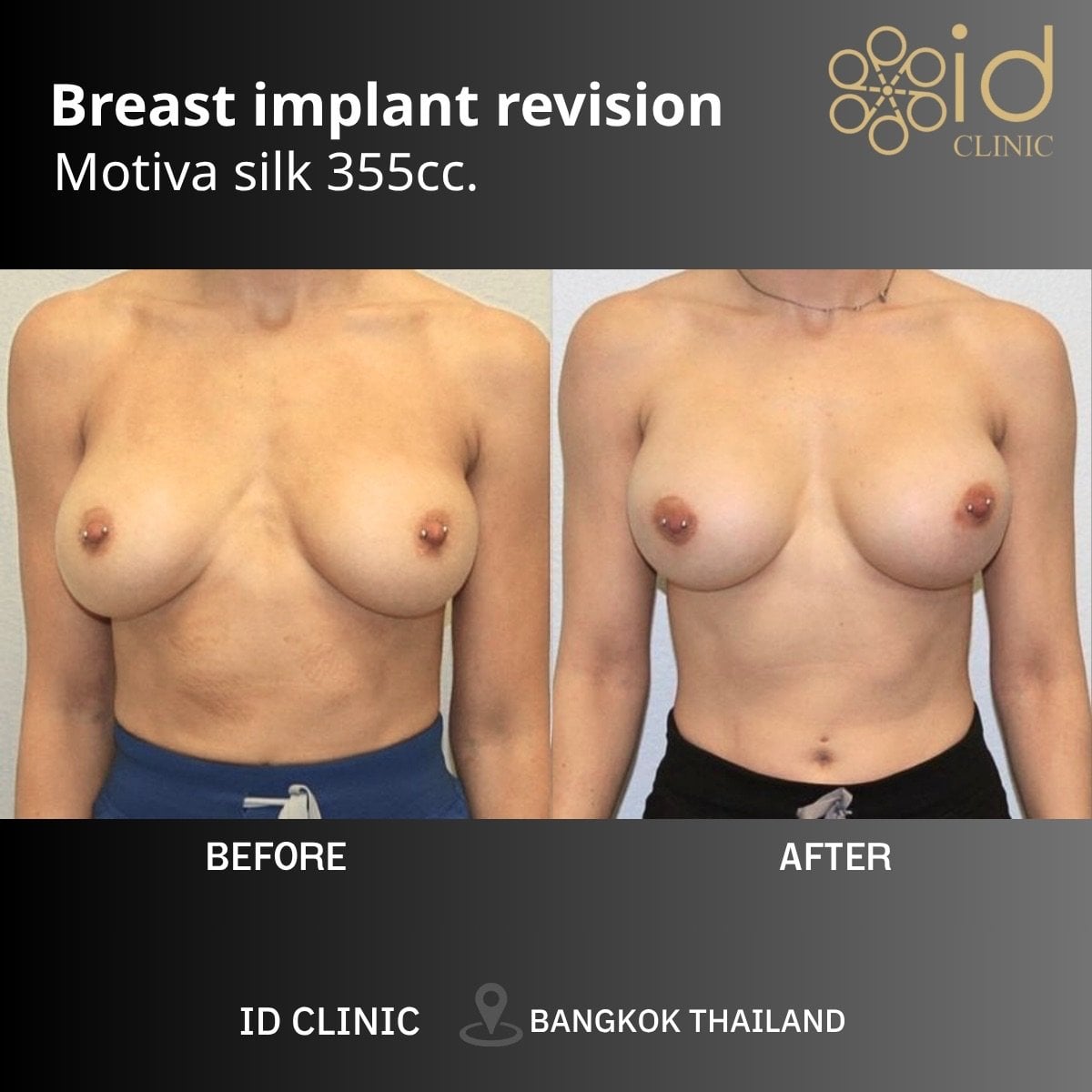نتائج قبل وبعد تصحيح زراعة الثدي Motiva 355cc في ID Clinic Bangkok